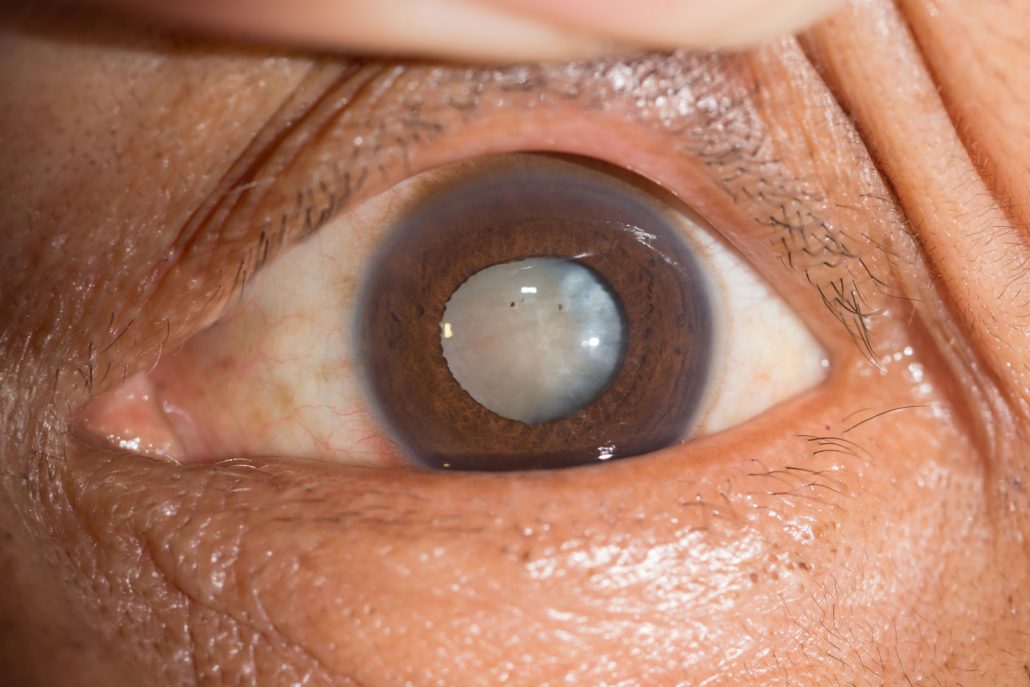 Cataracts Riverdale NJ