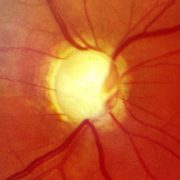 Glaucoma Riverdale NJ