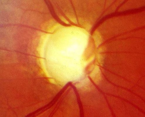 Glaucoma Riverdale NJ
