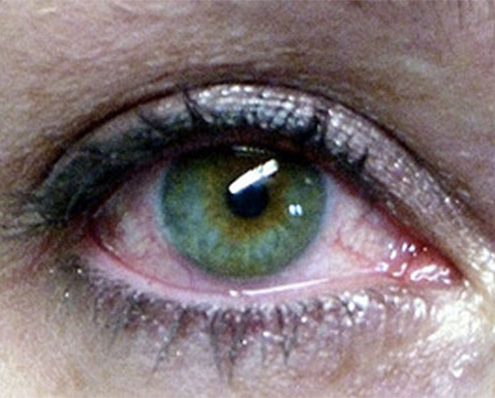 Dry Eyes Riverdale NJ