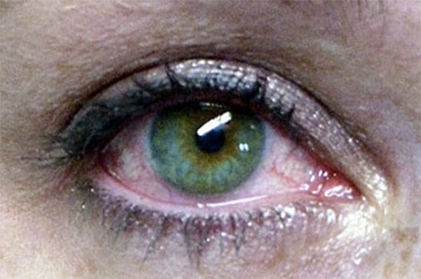 Dry Eyes Riverdale NJ Dry Eyes Riverdale NJ
