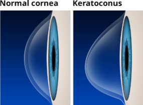 Keratoconus Riverdale Keratoconus Treatment Riverdale