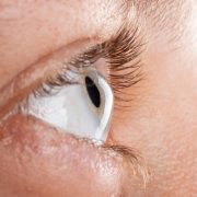 female-eye-diagnosed-with-keratoconus-corneal-thinning