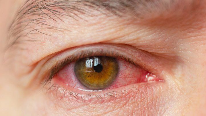 dry eye