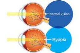 myopia